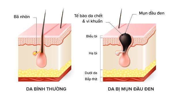 Mụn đầu đen xuất hiện do lỗ chân lông bị bít tắc bởi bụi bẩn và sợi bã nhờn