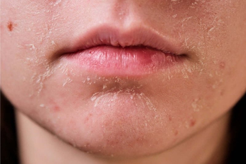 Người có da khô chọn sản phẩm cấp ẩm dịu nhẹ