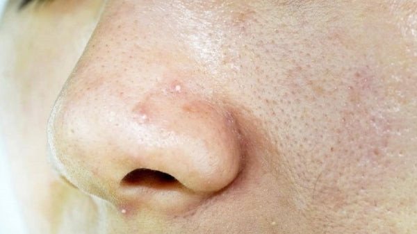 Người trẻ với làn da dầu và lỗ chân lông lớn cần chăm sóc chuyên biệt