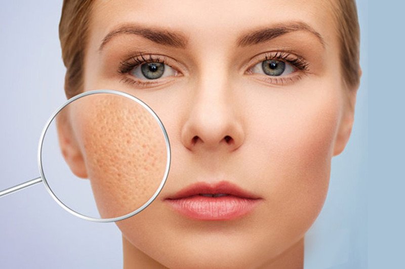Nguyên nhân chính gây lỗ chân lông to trên da mặt