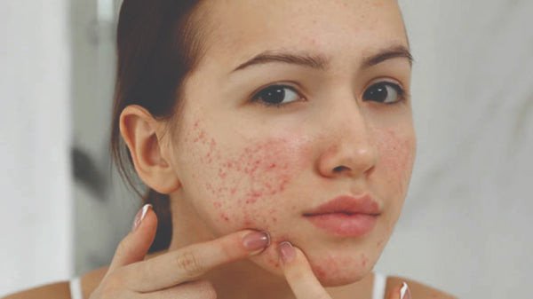 Những lầm tưởng thường gặp khi chăm sóc da mụn
