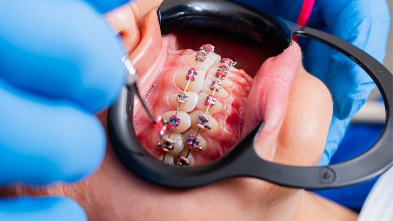 Niềng răng mắc cài là phương pháp chỉnh nha phổ biến, lâu đời và có hiệu quả cao trong điều trị răng hô