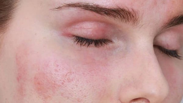 Nổi mề đay, mẩn đỏ là dấu hiệu dị ứng nước tẩy trang