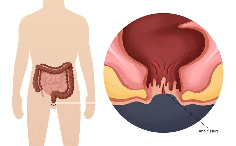 Nứt kẽ hậu môn gây chảy máu nhẹ khi đi đại tiện