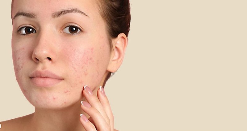 Phục hồi da nhạy cảm sau nặn mụn bằng các sản phẩm chuyên biệt