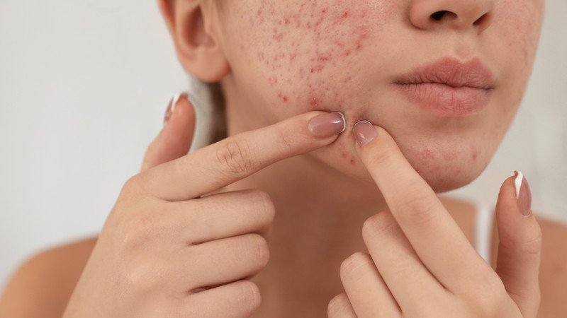Phương pháp ngăn ngừa mụn ẩn