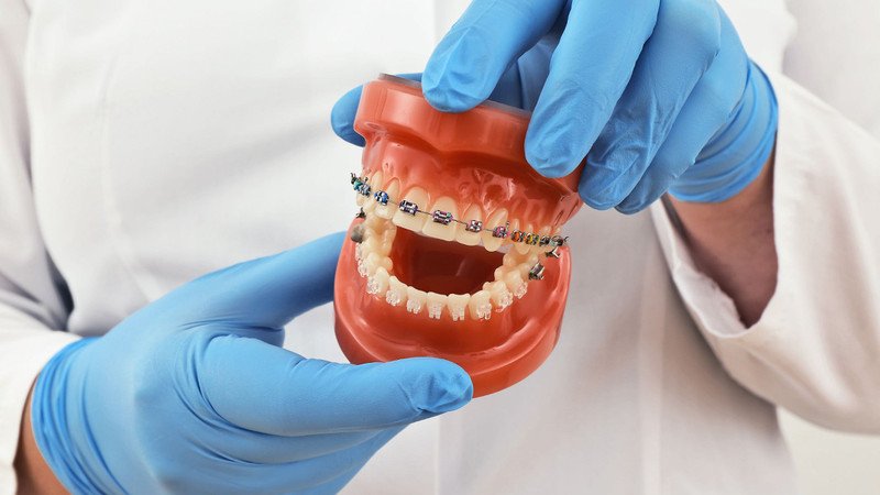 Phương pháp niềng là yếu tố quan trọng nhất quyết định chi phí niềng răng hô