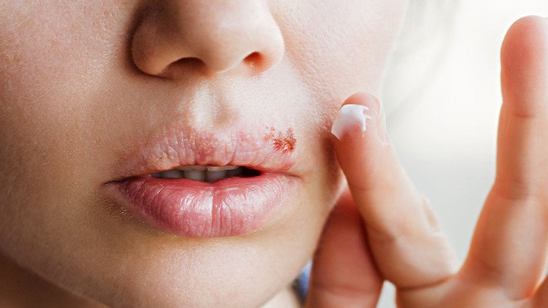 Quy trình chăm sóc hiệu quả cho vùng da mụn có vảy để da mau lành