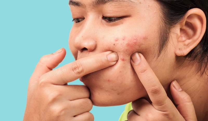 Quyết định nặn mụn cần cân nhắc kỹ lưỡng để tránh tổn thương da