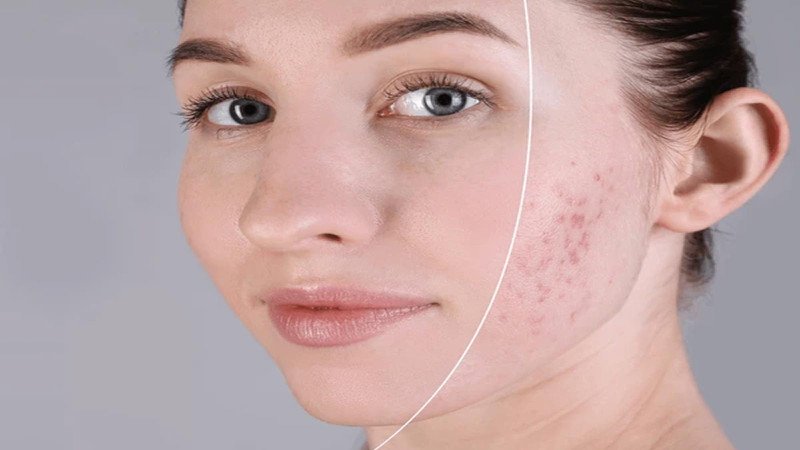 Rửa mặt đúng cách với nước vo gạo giúp kiểm soát mụn trứng cá