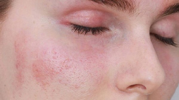 Sữa rửa mặt cho da nhạy cảm cần có thành phần làm sạch dịu nhẹ