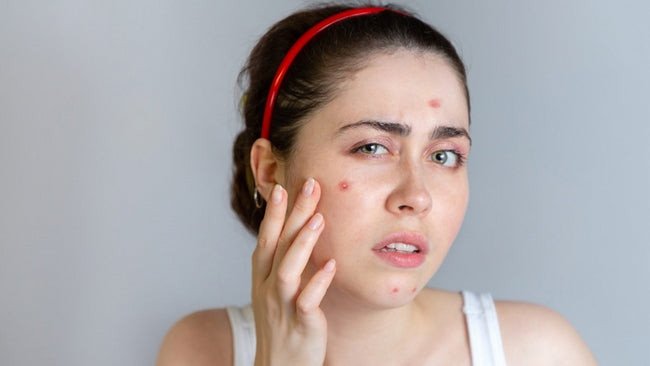 Sữa rửa mặt giúp ngăn ngừa và giảm thiểu tình trạng mụn
