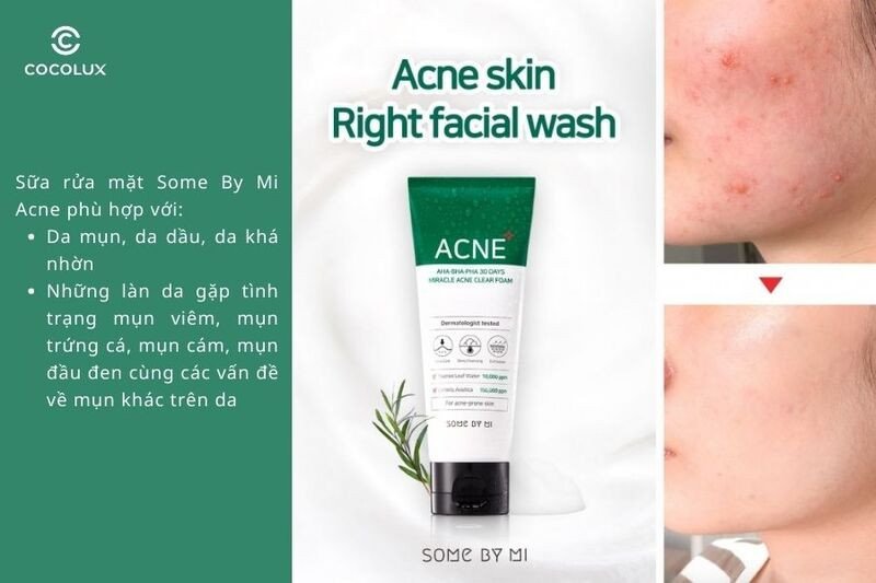Sữa rửa mặt Some By Mi Acne chuyên biệt cho làn da mụn nhạy cảm
