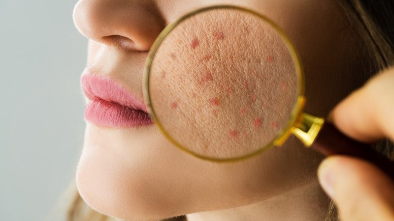 Sữa rửa mặt trị mụn ẩn hiệu quả nhất