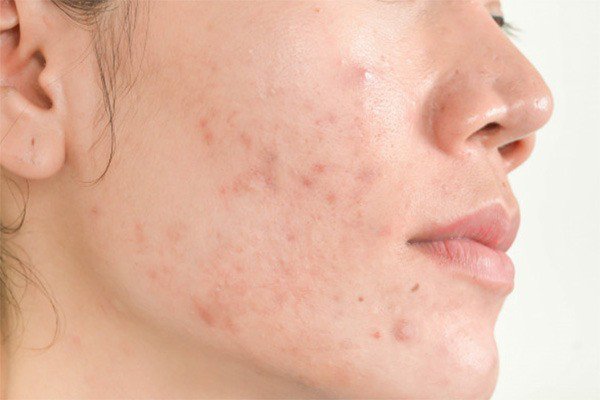 Tác hại của nước tẩy trang Simple giả gây kích ứng và dị ứng da