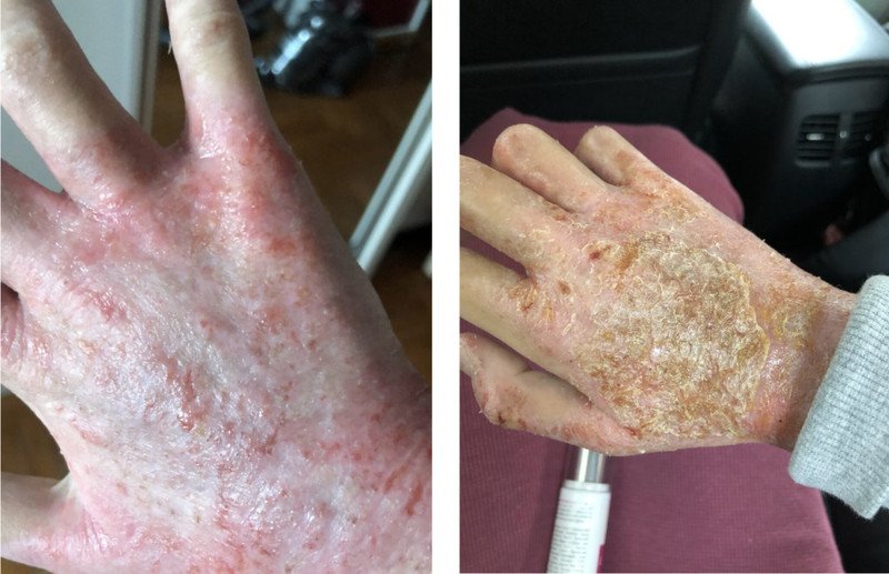 Tế bào da bị tổn thương do lạm dụng các sản phẩm chứa corticoid