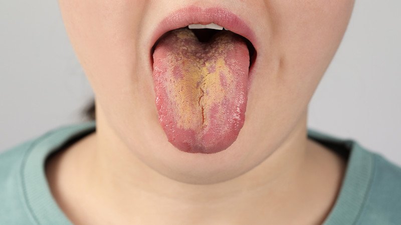 Thăm khám răng miệng định kỳ để phòng ngừa nấm lưỡi tái phát