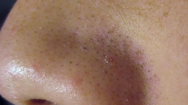 Thói quen chăm sóc da và lối sống lành mạnh giúp ngăn ngừa sợi bã nhờn hiệu quả