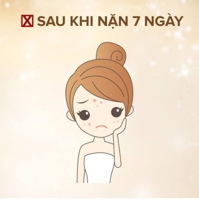 Tránh tẩy lông và laser sau nặn mụn