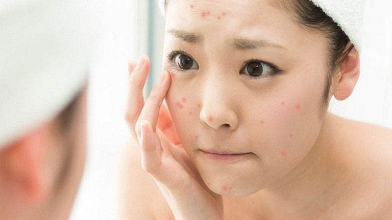 Tránh xông hơi mặt khi da đang gặp vấn đề mụn viêm hoặc tổn thương