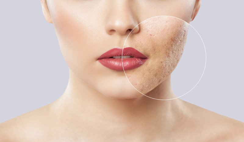 Tư vấn bác sĩ da liễu trước khi sử dụng BHA cho tình trạng mụn viêm nặng