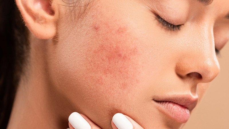 Vảy mụn tự nhiên trên da mặt bảo vệ vết thương khỏi nhiễm trùng