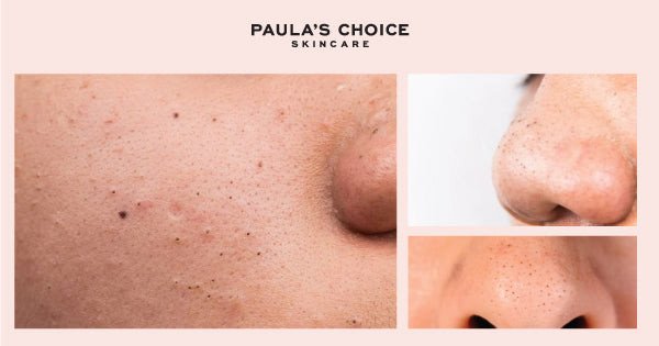Vị trí mụn đầu đen thường xuất hiện trên khuôn mặt và vùng chữ T